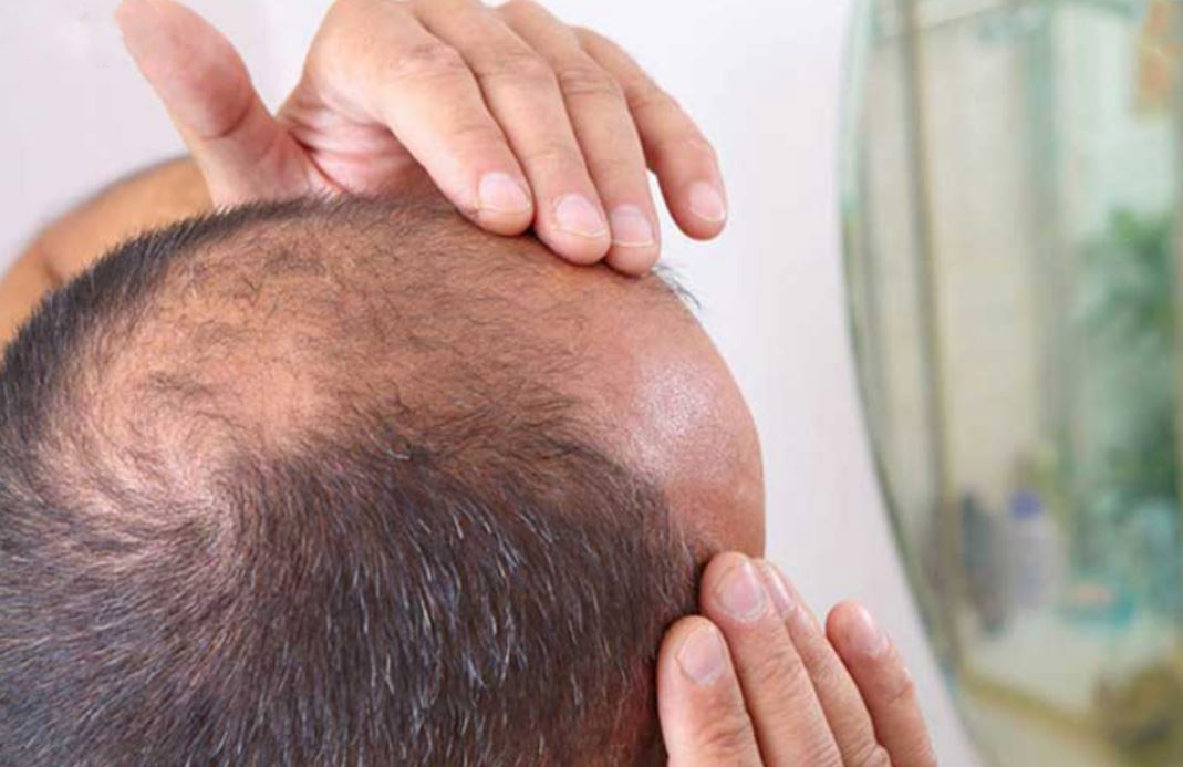 چاقی و ریزش مو چه ارتباطی با هم دارند؟