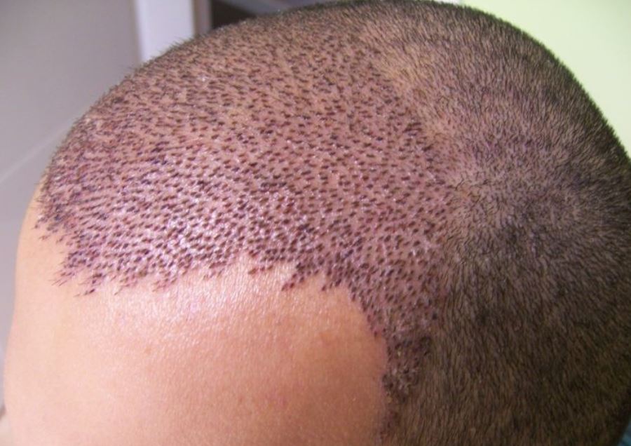 تاثیر قرص هیرویت بر روی موهای کاشته شده