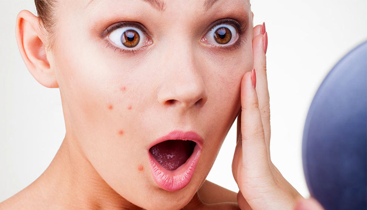 چه چیزی باعث ایجاد جوش می شود؟